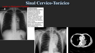 Lesão no Mediastino Posterior
 