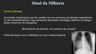 Sinal da Silhueta:
Uma lesão intratorácica que faz contato com os contornos da silhueta mediastínica
ou dos hemidiafragmas e que apresenta densidade radiológica idêntica irá apagar
esses contornos na radiografia.
“Borrramento da silhueta / do contorno do coração”
Pode acontecer com o diafragma ou com a fissura pleural
 