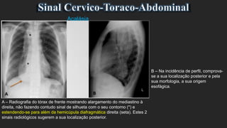 A – Radiografia do tórax de frente mostrando alargamento do mediastino à
direita, não fazendo contudo sinal de silhueta com o seu contorno (*) e
estendendo-se para além da hemicúpula diafragmática direita (seta). Estes 2
sinais radiológicos sugerem a sua localização posterior.
Acalásia
B – Na incidência de perfil, comprova-
se a sua localização posterior e pela
sua morfologia, a sua origem
esofágica.
 