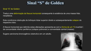 Sinal “S” de Golden:
Traduz uma deformação da fissura horizontal consequente à existência de uma massa hilar,
neoplásica.
Esta condiciona obstrução do brônquio lobar superior direito e subsequentemente colapso do
respectivo lobo.
A fissura horizontal que delimita estas alterações apresenta-se com a forma de um “S invertido”,
de concavidade inferior periférica (colapso pulmonar) e convexidade central (massa).
Sugere carcinoma broncogênico obstrutivo em um adulto.
 