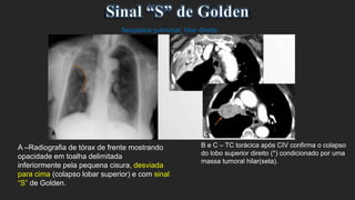 A –Radiografia de tórax de frente mostrando
opacidade em toalha delimitada
inferiormente pela pequena cisura, desviada
para cima (colapso lobar superior) e com sinal
“S” de Golden.
Neoplasia pulmonar, hilar direita.
B e C – TC torácica após CIV confirma o colapso
do lobo superior direito (*) condicionado por uma
massa tumoral hilar(seta).
 