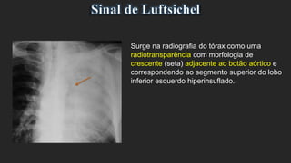 Surge na radiografia do tórax como uma
radiotransparência com morfologia de
crescente (seta) adjacente ao botão aórtico e
correspondendo ao segmento superior do lobo
inferior esquerdo hiperinsuflado.
 