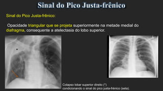 Sinal do Pico Justa-frênico:
Opacidade triangular que se projeta superiormente na metade medial do
diafragma, consequente a atelectasia do lobo superior.
Colapso lobar superior direito (*)
condicionando o sinal do pico justa-frénico (seta).
 