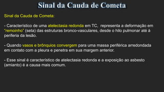 Sinal da Cauda de Cometa:
- Característico de uma atelectasia redonda em TC, representa a deformação em
“remoinho” (seta) das estruturas bronco-vasculares, desde o hilo pulmonar até à
periferia da lesão.
- Quando vasos e brônquios convergem para uma massa periférica arredondada
em contato com a pleura e penetra em sua margem anterior.
- Esse sinal é característico de atelectasia redonda e a exposição ao asbesto
(amianto) é a causa mais comum.
 
