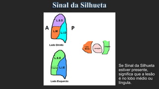 Se Sinal da Silhueta
estiver presente,
significa que a lesão
é no lobo médio ou
língula.
 