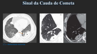 (*) – atelectasia redonda
 