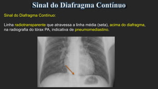 Sinal do Diafragma Contínuo:
Linha radiotransparente que atravessa a linha média (seta), acima do diafragma,
na radiografia do tórax PA, indicativa de pneumomediastino.
 