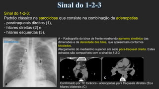 Sinal do 1-2-3:
Padrão clássico na sarcoidose que consiste na combinação de adenopatias
- paratraqueais direitas (1),
- hilares direitas (2) e
- hilares esquerdas (3).
A – Radiografia do tórax de frente mostrando aumento simétrico das
dimensões e da densidade dos hilos, que apresentam contornos
lobulados.
Alargamento do mediastino superior em sede para-traqueal direita. Estes
achados são compatíveis com o sinal do 1-2-3
Sarcoidose
Confirmado por TC torácica - adenopatias para traqueais direitas (B) e
hilares bilaterais (C)
 