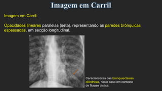 Imagem em Carril:
Opacidades lineares paralelas (seta), representando as paredes brônquicas
espessadas, em secção longitudinal.
Características das bronquiectasias
cilíndricas, neste caso em contexto
de fibrose cística.
 