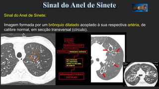 Sinal do Anel de Sinete:
Imagem formada por um brônquio dilatado acoplado à sua respectiva artéria, de
calibre normal, em secção transversal (círculo).
 