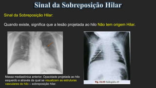 Sinal da Sobreposição Hilar:
Quando existe, significa que a lesão projetada ao hilo Não tem origem Hilar.
Massa mediastínica anterior. Opacidade projetada ao hilo
esquerdo e através da qual se visualizam as estruturas
vasculares do hilo – sobreposição hilar.
 