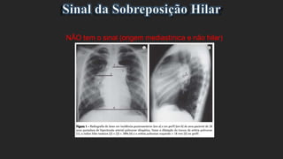 NÃO tem o sinal (origem mediastínica e não hilar)
 