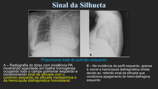 Pneumonia total do pulmão esquerdo
A – Radiografia do tórax com incidência PA
mostrando opacidade em toalha homogénea
ocupando todo o campo pulmonar esquerdo e
condicionando sinal de silhueta com o
contorno esquerdo da silhueta mediastínica e
da hemicúpula diafragmática homolateral.
B – Na incidência de perfil esquerdo, apenas
é visível a hemicúpula diafragmática direita
devido ao referido sinal da silhueta que
condiciona apagamento do hemi-diafragma
esquerdo
 