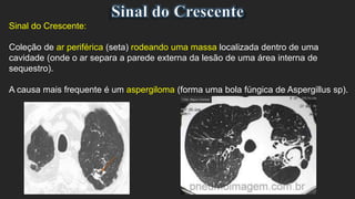 Sinal do Crescente:
Coleção de ar periférica (seta) rodeando uma massa localizada dentro de uma
cavidade (onde o ar separa a parede externa da lesão de uma área interna de
sequestro).
A causa mais frequente é um aspergiloma (forma uma bola fúngica de Aspergillus sp).
 