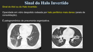 Sinal do Atol ou do Halo Invertido:
Opacidade em vidro despolido rodeada por halo periférico mais denso (aneis de
consolidação).
É patognomônico de pneumonia organizativa.
 