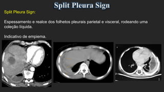 Split Pleura Sign:
Espessamento e realce dos folhetos pleurais parietal e visceral, rodeando uma
coleção líquida.
Indicativo de empiema.
 