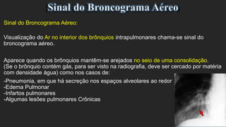 Sinal do Broncograma Aéreo:
Visualização do Ar no interior dos brônquios intrapulmonares chama-se sinal do
broncograma aéreo.
Aparece quando os brônquios mantêm-se arejados no seio de uma consolidação.
(Se o brônquio contém gás, para ser visto na radiografia, deve ser cercado por matéria
com densidade água) como nos casos de:
-Pneumonia, em que há secreção nos espaços alveolares ao redor
-Edema Pulmonar
-Infartos pulmonares
-Algumas lesões pulmonares Crônicas
 