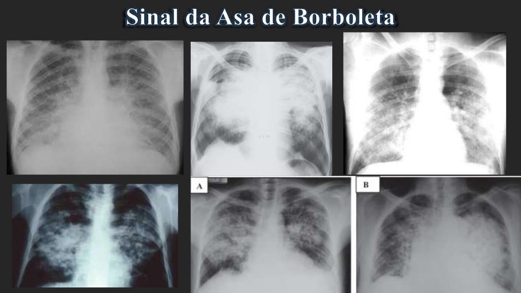 Sinais do Raio X de Tórax