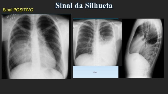 Sinais do Raio X de Tórax