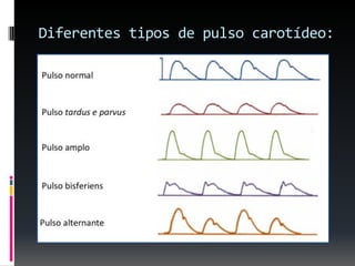 Diferentes tipos de pulso carotídeo:

 