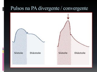 Pulsos na PAdivergente / convergente
 