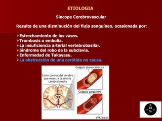 Sincope Cerebrovascular   ETIOLOGIA Resulta de una disminución del flujo sanguíneo, ocasionada por: Estrechamiento de los vasos.  Trombosis o embolia.  La insuficiencia arterial vertebrobasilar. Síndrome del robo de la subclavia. Enfermedad de Takayasu.  La obstrucción de una carótida no causa.   