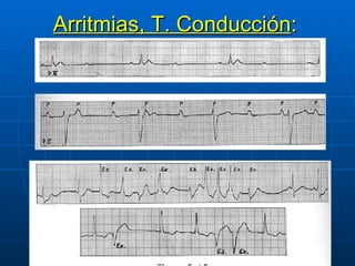 Arritmias, T. Conducción : 