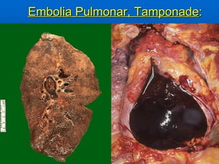 Embolia Pulmonar, Tamponade : 