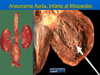 Aneurisma Aorta, Infarto al Miocardio: 
