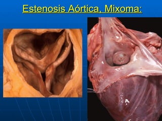 Estenosis Aórtica, Mixoma: 