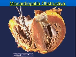 Miocardiopatía Obstructiva: 
