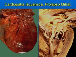 Cardiopatía Isquémica, Prolapso Mitral: 