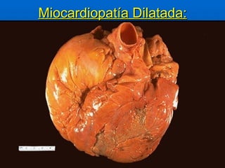 Miocardiopatía Dilatada: 