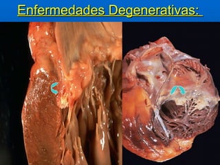 Enfermedades Degenerativas:  
