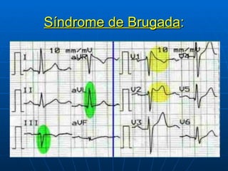 Síndrome de Brugada : 