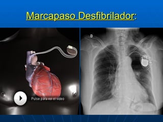 Marcapaso Desfibrilador : 