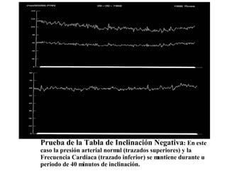 Prueba de la Tabla de Inclinación Negativa : En este caso la presión arterial normal (trazados superiores) y la Frecuencia Cardiaca (trazado inferior) se mantiene durante u  periodo de 40 minutos de inclinación.  