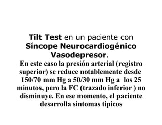 Tilt Test  en un paciente con  Síncope Neurocardiogénico Vasodepresor .  En este caso la presión arterial (registro superior) se reduce notablemente desde  150/70 mm Hg a 50/30 mm Hg a  los 25 minutos, pero la FC (trazado inferior ) no disminuye. En ese momento, el paciente desarrolla sintomas tipicos 