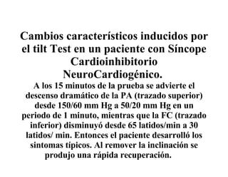 Cambios característicos inducidos por el tilt Test en un paciente con Síncope Cardioinhibitorio NeuroCardiogénico.  A los 15 minutos de la prueba se advierte el descenso dramático de la PA (trazado superior) desde 150/60 mm Hg a 50/20 mm Hg en un periodo de 1 minuto, mientras que la FC (trazado inferior) disminuyó desde 65 latidos/min a 30 latidos/ min. Entonces el paciente desarrolló los sintomas típicos. Al remover la inclinación se produjo una rápida recuperación. 
