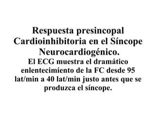 Respuesta presincopal Cardioinhibitoria en el Síncope  Neurocardiogénico. El ECG muestra el dramático enlentecimiento de la FC desde 95 lat/min a 40 lat/min justo antes que se produzca el síncope. 
