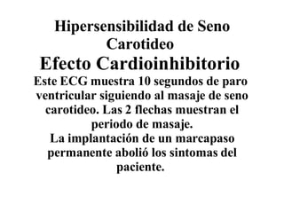 Hipersensibilidad de Seno Carotideo  Efecto Cardioinhibitorio  Este ECG muestra 10 segundos de paro  ventricular siguiendo al masaje de seno carotideo. Las 2 flechas muestran el periodo de masaje. La implantación de un marcapaso permanente abolió los sintomas del paciente.  