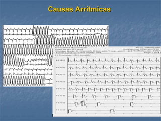Causas Arrítmicas
 