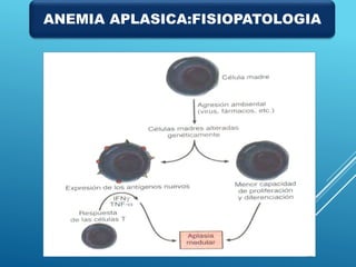 ANEMIA APLASICA:FISIOPATOLOGIA
 