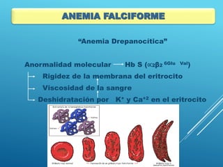 “Anemia Drepanocítica”
Anormalidad molecular Hb S (∝2β2 6Glu Val)
Rigidez de la membrana del eritrocito
Viscosidad de la sangre
Deshidratación por K+ y Ca+2 en el eritrocito
ANEMIA FALCIFORME
 