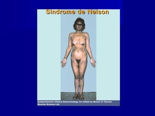 Sindrome de NelsonSindrome de Nelson
 