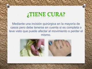 Mediante una incisión quirúrgica en la mayoría de
casos pero debe tenerse en cuenta si es completa o
leve visto que puede afectar al movimiento o perder el
mismo.
 