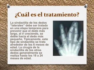 La sindactilia de los dedos
“laterales” debe ser tratada
en una etapa temprana para
prevenir que el dedo más
largo, al ir creciendo, se
doble hacia el dedo más
pequeño. Típicamente, este
tipo de sindactilia se trata
alrededor de los 6 meses de
edad. La cirugía de la
sindactilia de los otros
dedos generalmente se
realiza hasta los 18 a 24
meses de edad.
 
