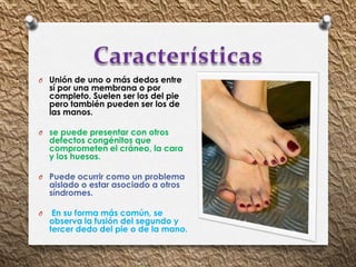O Unión de uno o más dedos entre
sí por una membrana o por
completo. Suelen ser los del pie
pero también pueden ser los de
las manos.
O se puede presentar con otros
defectos congénitos que
comprometen el cráneo, la cara
y los huesos.
O Puede ocurrir como un problema
aislado o estar asociado a otros
síndromes.
O En su forma más común, se
observa la fusión del segundo y
tercer dedo del pie o de la mano.
 