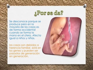 Se desconoce porque se
produce pero en la
mayoría de los casos es
de forma accidental
cuando se forma la
mano en el útero. Afecta
igual a niños y niñas.
los casos son debidos a
herencia familiar, está en
los genes y pueden ser
pasados de generación
en generación.
 