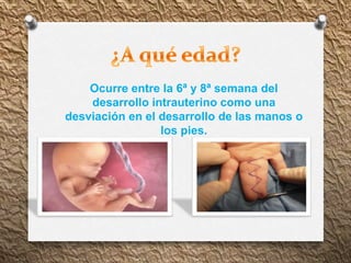 Ocurre entre la 6ª y 8ª semana del
desarrollo intrauterino como una
desviación en el desarrollo de las manos o
los pies.
 